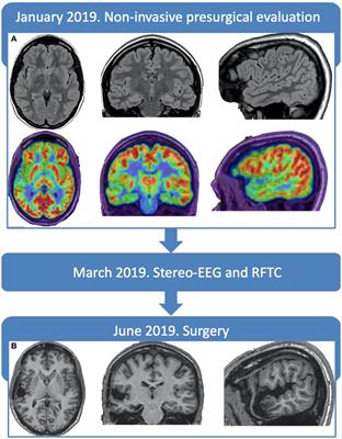 Language lateralization mapping (reversibly) masked by non-dominant focal epilepsy: a case report